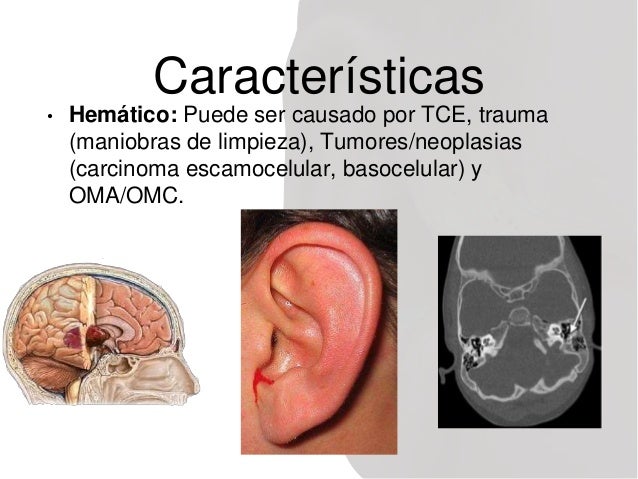 barotrauma otic barotrauma otic