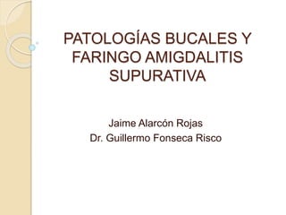PATOLOGÍAS BUCALES Y
FARINGO AMIGDALITIS
SUPURATIVA
Jaime Alarcón Rojas
Dr. Guillermo Fonseca Risco
 