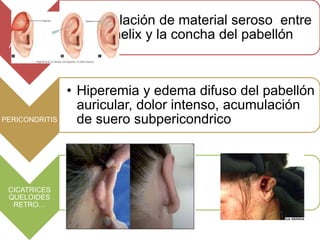 SEROMA
AURICULAR
• Acumulación de material seroso entre
el antihelix y la concha del pabellón
PERICONDRITIS
• Hiperemia y edema difuso del pabellón
auricular, dolor intenso, acumulación
de suero subpericondrico
CICATRICES
QUELOIDES
RETRO…
 