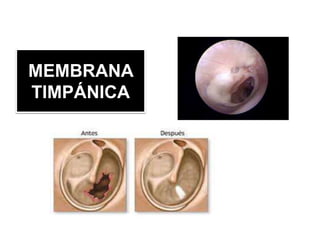 MEMBRANA
TIMPÁNICA
 