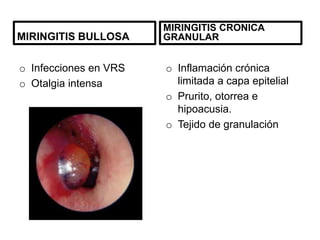 MIRINGITIS BULLOSA
o Infecciones en VRS
o Otalgia intensa
MIRINGITIS CRONICA
GRANULAR
o Inflamación crónica
limitada a capa epitelial
o Prurito, otorrea e
hipoacusia.
o Tejido de granulación
 