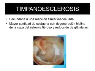 TIMPANOESCLEROSIS
• Secundaria a una reacción tisular inadecuada.
• Mayor cantidad de colágena con degeneración hialina
de la capa del estroma fibroso y reducción de glándulas.
 