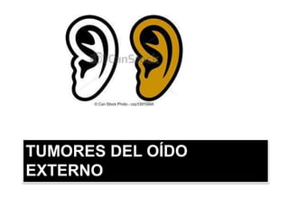 TUMORES DEL OÍDO
EXTERNO
 