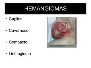 HEMANGIOMAS
• Capilar
• Cavernoso
• Compacto
• Linfangioma
 