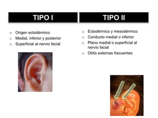TIPO I
o Origen ectodérmico
o Medial, inferior y posterior
o Superficial al nervio facial
TIPO II
o Ectodérmico y mesodérmico
o Conducto medial o inferior
o Plano medial o superficial al
nervio facial
o Otitis externas frecuentes
 