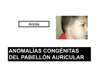 ANOMALÍAS CONGÉNITAS
DEL PABELLÓN AURICULAR
Anotia
 