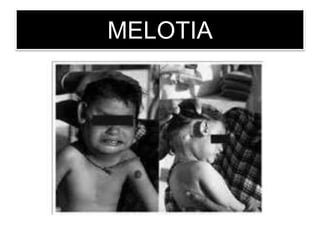 MELOTIA
 