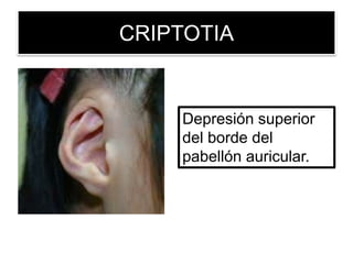 CRIPTOTIA
Depresión superior
del borde del
pabellón auricular.
 
