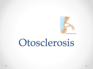 Otosclerosis
 