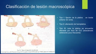 Clasificación de lesión macroscópica
• Tipo I: fijación de la platina en borde
anterior de venta.
• Tipo II: afectación de hemiplatina
• Tipo III: toda la platina se encuentra
afectada por foco de O.E (otosclerosis
obliterante poco frecuente)
 