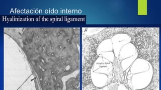 Afectación oído interno
 