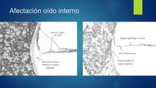 Afectación oído interno
 