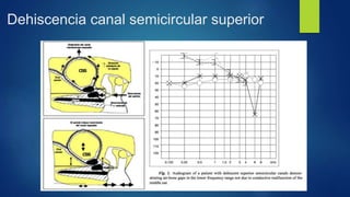 Dehiscencia canal semicircular superior
 