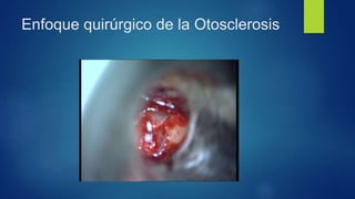 Enfoque quirúrgico de la Otosclerosis
 