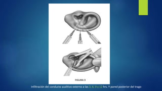 Infiltración del conducto auditivo externo a las 3, 6, 9 y 12 hrs. Y pared posterior del trago
 