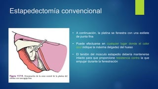 Estapedectomía convencional
• A continuación, la platina se fenestra con una estilete
de punta fina
• Puede efectuarse en cualquier lugar donde el color
azul indique la máxima delgadez del hueso
• El tendón del músculo estapedio debería mantenerse
intacto para que proporcione resistencia contra la que
empujar durante la fenestración
 