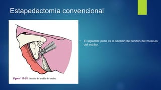 Estapedectomía convencional
• El siguiente paso es la sección del tendón del músculo
del estribo.
 