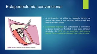 Estapedectomía convencional
• A continuación, se utiliza un pequeño gancho de
platina para resecar una cantidad suficiente del área
central de dicha platina
• La cantidad de platina que se reseca es la porción que
se puede extraer con facilidad, lo que suele constituir
alrededor del 25% de su superficie: platinectomia
parcial. Otros preconizan platinectomia total o subtotal.
 