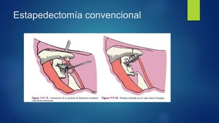 Estapedectomía convencional
 