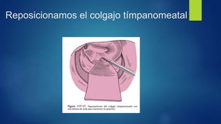 Reposicionamos el colgajo tímpanomeatal
 