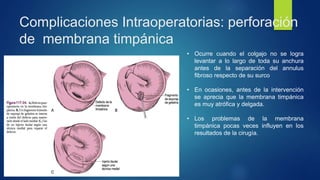 Complicaciones Intraoperatorias: perforación
de membrana timpánica
• Ocurre cuando el colgajo no se logra
levantar a lo largo de toda su anchura
antes de la separación del annulus
fibroso respecto de su surco
• En ocasiones, antes de la intervención
se aprecia que la membrana timpánica
es muy atrófica y delgada.
• Los problemas de la membrana
timpánica pocas veces influyen en los
resultados de la cirugía.
 