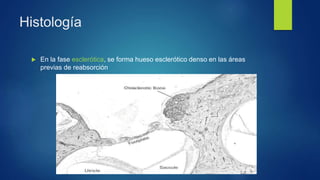 Histología
 En la fase esclerótica, se forma hueso esclerótico denso en las áreas
previas de reabsorción
 