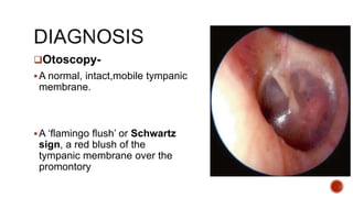 Otosclerosis | PPT