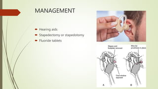 MANAGEMENT
 Hearing aids
 Stapedectomy or stapedotomy
 Fluoride tablets
 