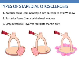 TYPES OF STAPEDIAL OTOSCLEROSIS
1. Anterior focus (commonest): 2 mm anterior to oval Window
2. Posterior focus: 2 mm behind oval window
3. Circumferential: involves footplate margin only
 