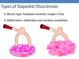 Types of Stapedial Otosclerosis
4. Biscuit type: footplate involved, margin is free
5. Obliterative: obliterates oval window completely
 