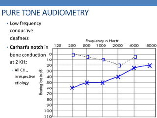 PURE TONE AUDIOMETRY
• Low frequency
conductive
deafness
• Carhart’s notch in
bone conduction
at 2 KHz
• All CHL,
irrespective
etiology
 