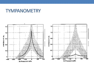 TYMPANOMETRY
 