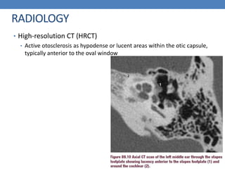 RADIOLOGY
• High-resolution CT (HRCT)
• Active otosclerosis as hypodense or lucent areas within the otic capsule,
typically anterior to the oval window
 