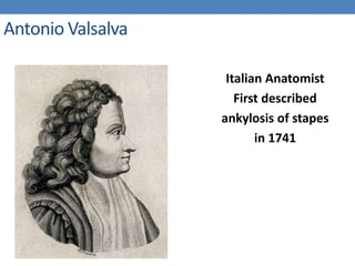 Antonio Valsalva
Italian Anatomist
First described
ankylosis of stapes
in 1741
 