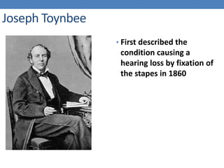 Joseph Toynbee
• First described the
condition causing a
hearing loss by fixation of
the stapes in 1860
 