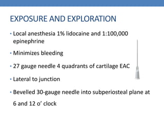EXPOSURE AND EXPLORATION
• Local anesthesia 1% lidocaine and 1:100,000
epinephrine
• Minimizes bleeding
• 27 gauge needle 4 quadrants of cartilage EAC
• Lateral to junction
• Bevelled 30-gauge needle into subperiosteal plane at
6 and 12 o’ clock
 