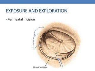 EXPOSURE AND EXPLORATION
• Permeatal incision
 