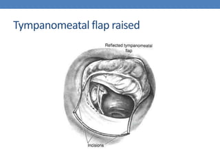 Tympanomeatal flap raised
 