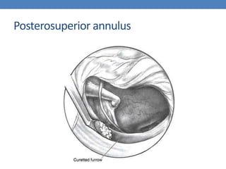 Posterosuperior annulus
 