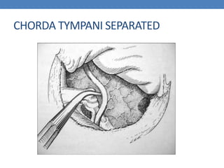CHORDA TYMPANI SEPARATED
 