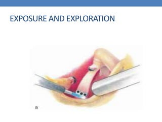 EXPOSURE AND EXPLORATION
 