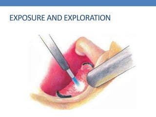 EXPOSURE AND EXPLORATION
 