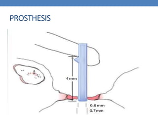PROSTHESIS
 