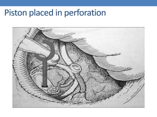 Piston placed in perforation
 