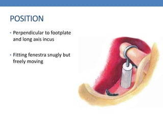 POSITION
• Perpendicular to footplate
and long axis incus
• Fitting fenestra snugly but
freely moving
 