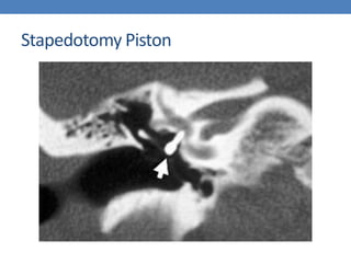 Stapedotomy Piston
 