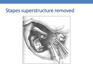 Stapes superstructure removed
 