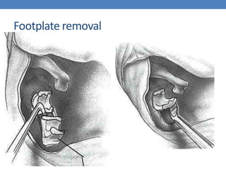 Footplate removal
 