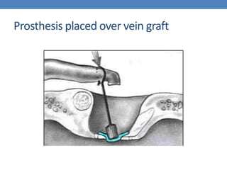 Prosthesis placed over vein graft
 