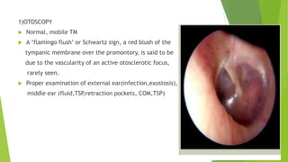 1)OTOSCOPY
 Normal, mobile TM
 A ‘flamingo flush’ or Schwartz sign, a red blush of the
tympanic membrane over the promontory, is said to be
due to the vascularity of an active otosclerotic focus,
rarely seen.
 Proper examination of external ear(infection,exostosis),
middle ear (fluid,TSP,retraction pockets, COM,TSP)
 